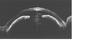 nanophthalmos-as-oct-image3
